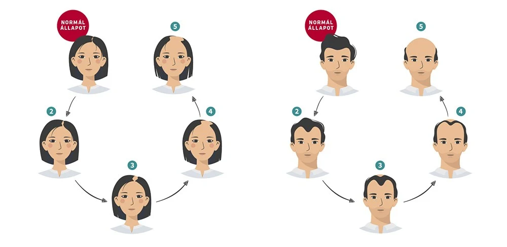 Az androgén alopécia hajhullási mintázatai - a milliókat érintő hajhullás