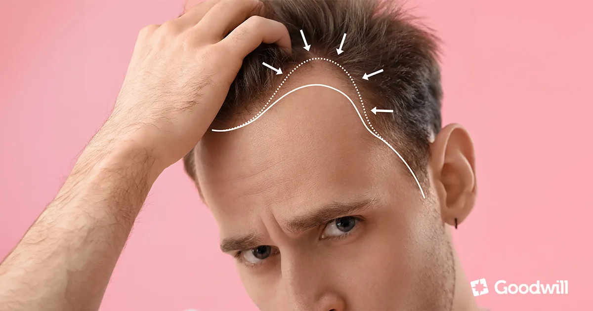 Androgén alopécia, a milliókat érintő hajhullás